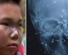 Young girl left with 68 pieces of shot gun shell left in her face after being accidentally shot by brother